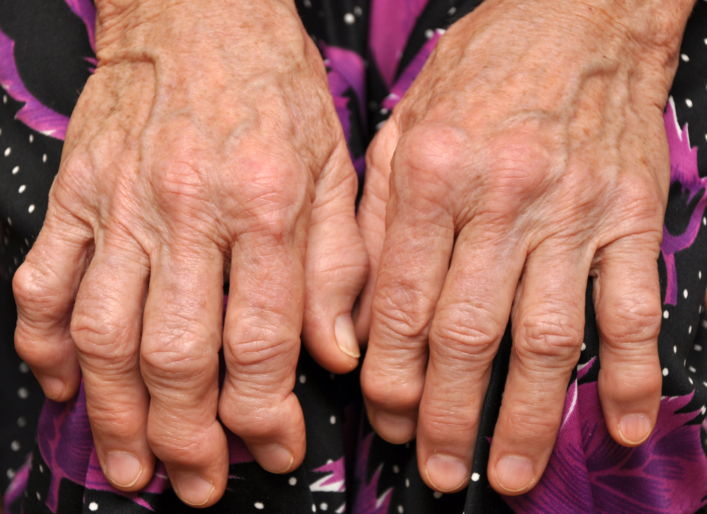 Elderly hands suffering from Arthritis